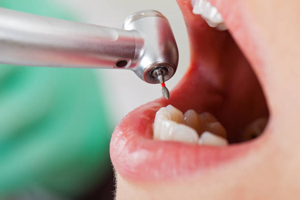 Best Knocked-Out Tooth (Avulsed Tooth) Treatment in Piketon, OH